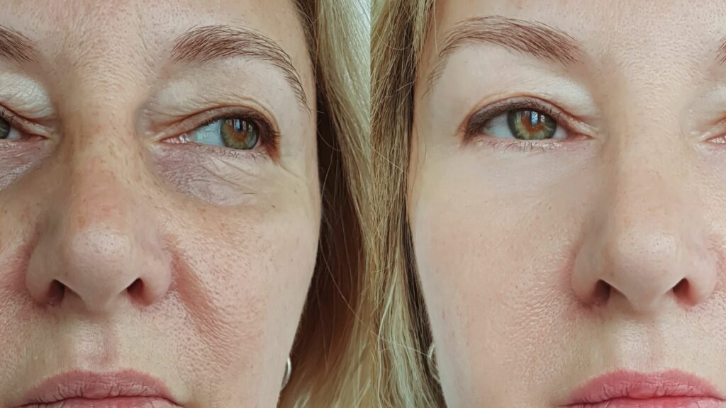 Tretinoin before and after